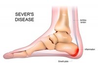 Overview and Relief Methods for Sever’s Disease